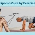 The Role of Exercise in Lipoma Management