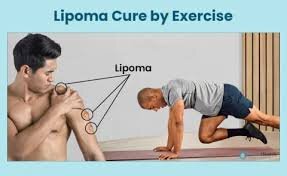 The Role of Exercise in Lipoma Management